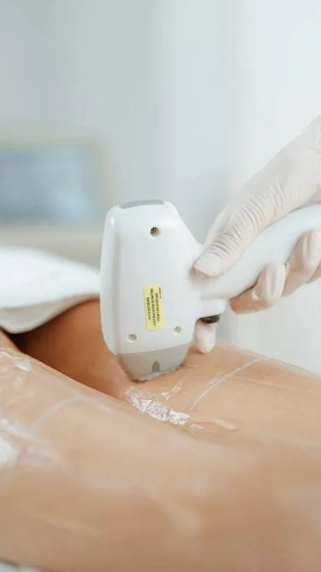 Laser hair removal on the leg at RJ Aesthetics